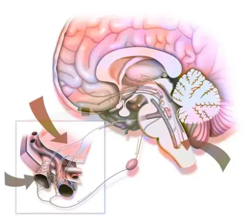 Advanced Clinical Insights into Glossopharyngeal Neuralgia: From Pathophysiology to Surgical Intervention
